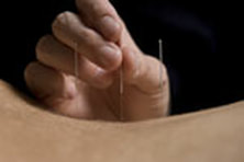 Back Acupuncture Picture