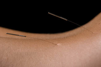 Back Acupuncture Picture